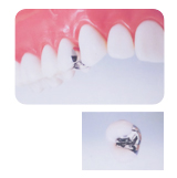 銀　歯
