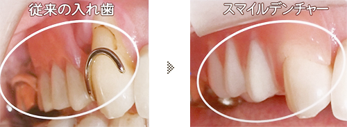 スマイルデンチャー