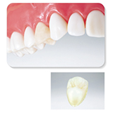 ジルコニアPure Pearl