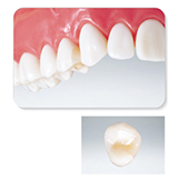 オールセラミックス